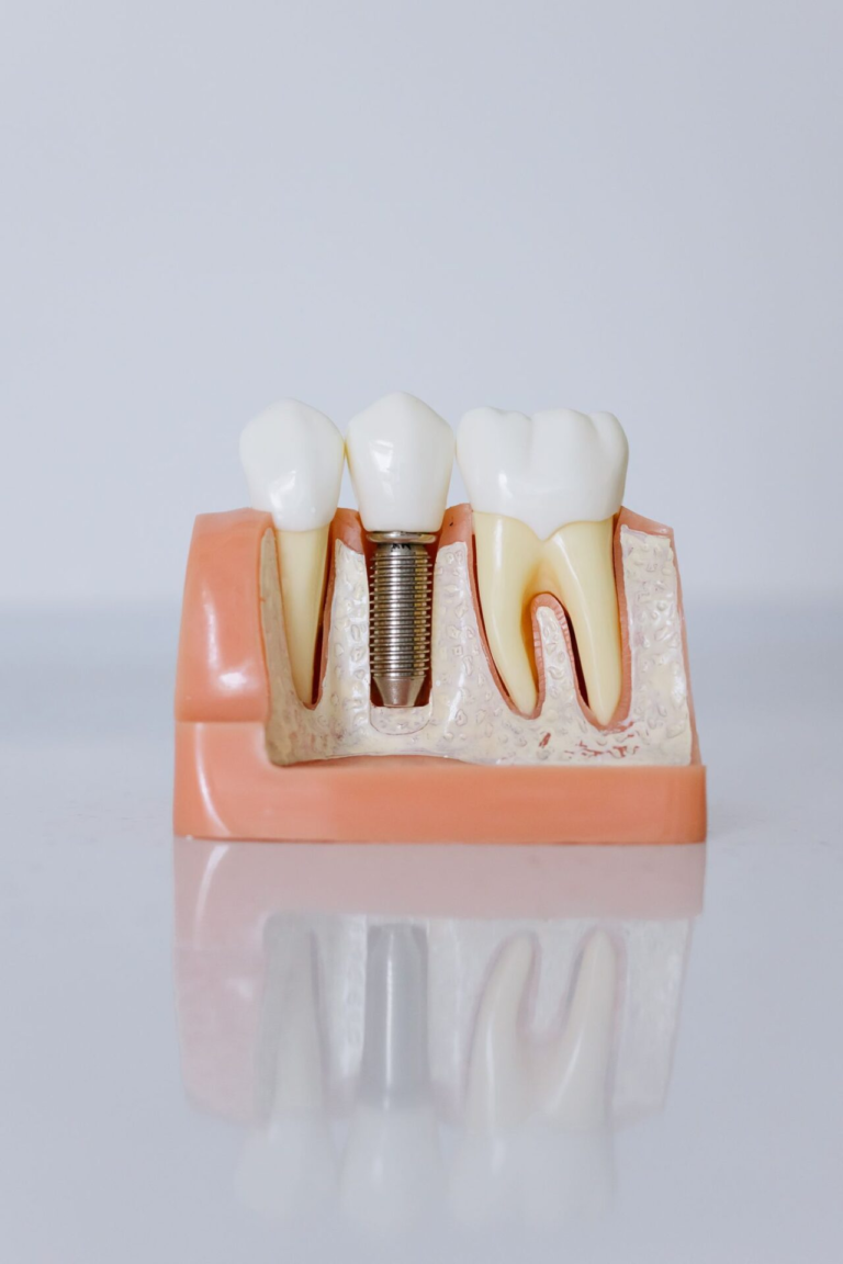 Model szczęki pokazujący implant zębowy