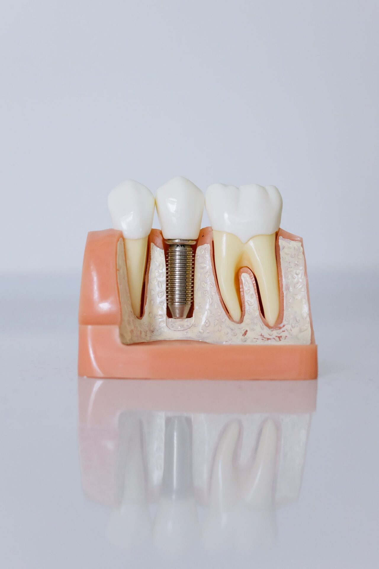 Model szczęki pokazujący implant zębowy